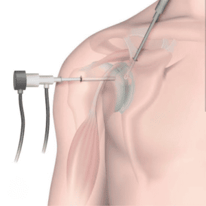 Subacromial Decompression